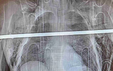 Při pádu ze žebříku spadl na kovovou tyč. Muž je po náročné operaci doma