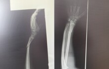 Trampolína není chůva, úrazy dětí každoročně přibývají