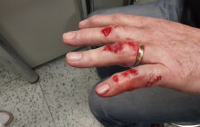 Skřípnul si ruku ve dveřích, zachránil jej snubák. Hasiči prsten museli rozřezat