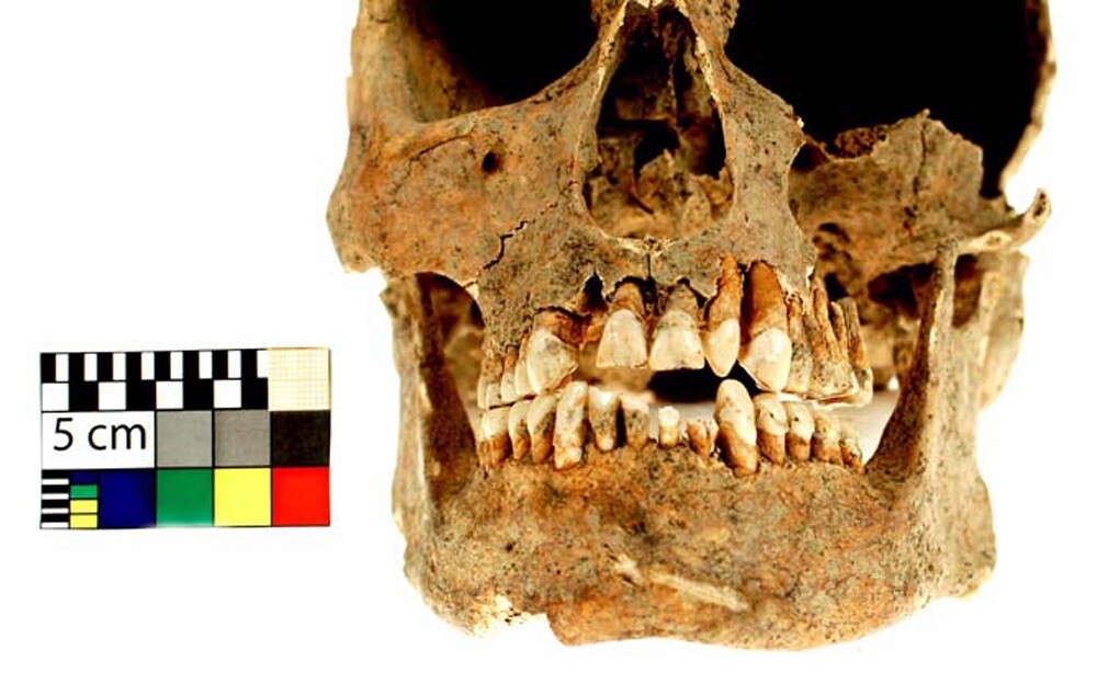 Poškození dentice, zdroj: Archeologické centrum Olomouc